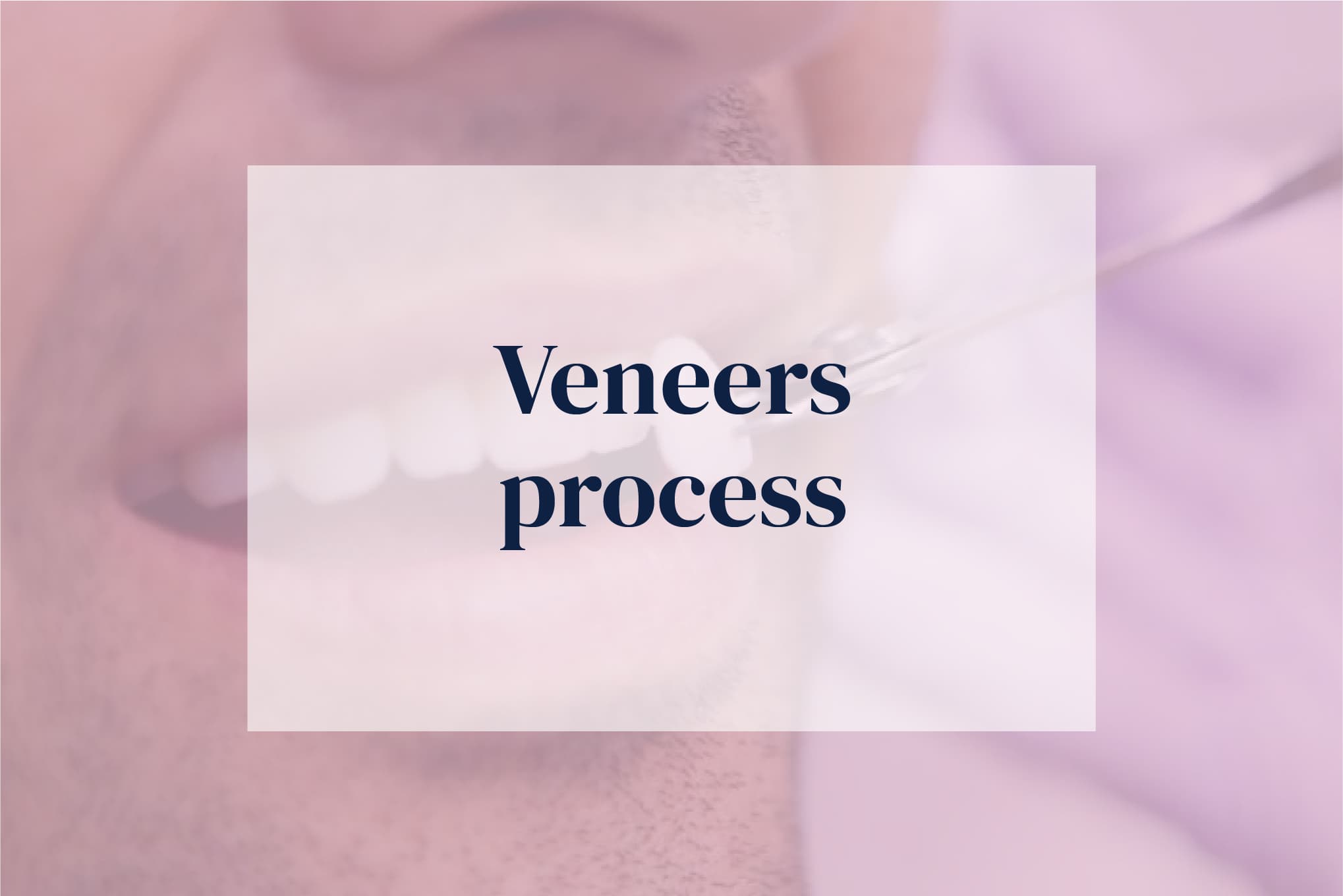 Trident Smiles Dental Veneers process stepbystep guide to the